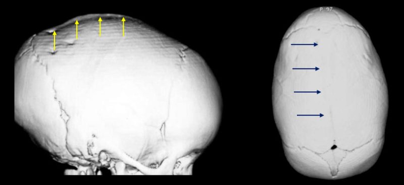 cranioestenose-01.jpg